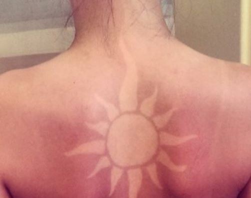 Дерматолог: "солнечные татуировки" опасны для здоровья